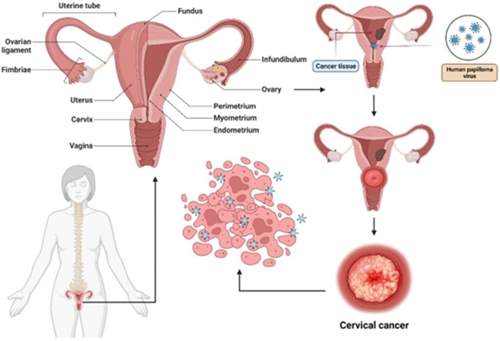 Darstellung von Gebärmutterhalskrebs. Credits: Genes & Diseases