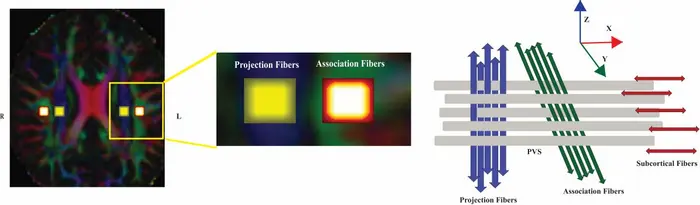 Diffusion MRI of brain white matter with zoomed in insets comparing projection and association fibers then a schematic of fiber tracts