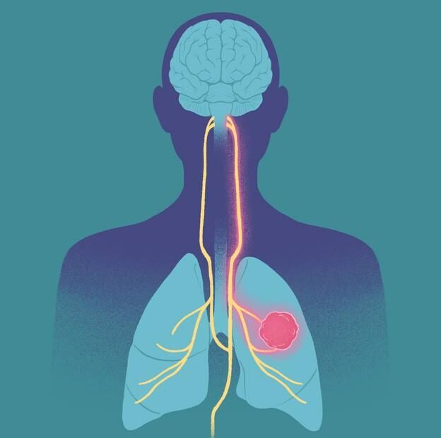 • LabNews AI Anatomical illustration of the brain spinal cord and lungs with a pink tumor in one lung