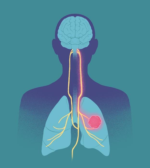 Anatomical illustration of the brain spinal cord and lungs with a pink tumor in one lung