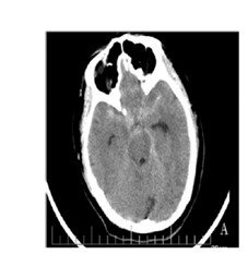 LVIS-Stent verändert Blutfluss in Hirnaneurysmen günstig