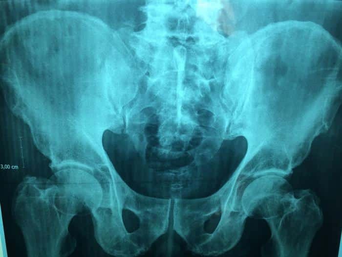 AP pelvic X ray showing pelvis both hip joints and proximal femurs
